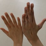 患者（右）和一般人（左）的手指對比。（記者攝）